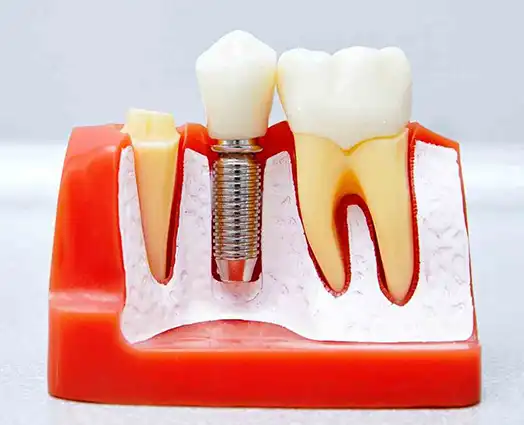 Dental Implant Post Operative Instructions