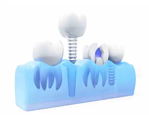 Pre-Operative Instructions for Dental Implants