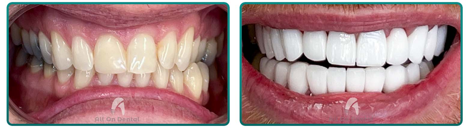 Veneers case 4