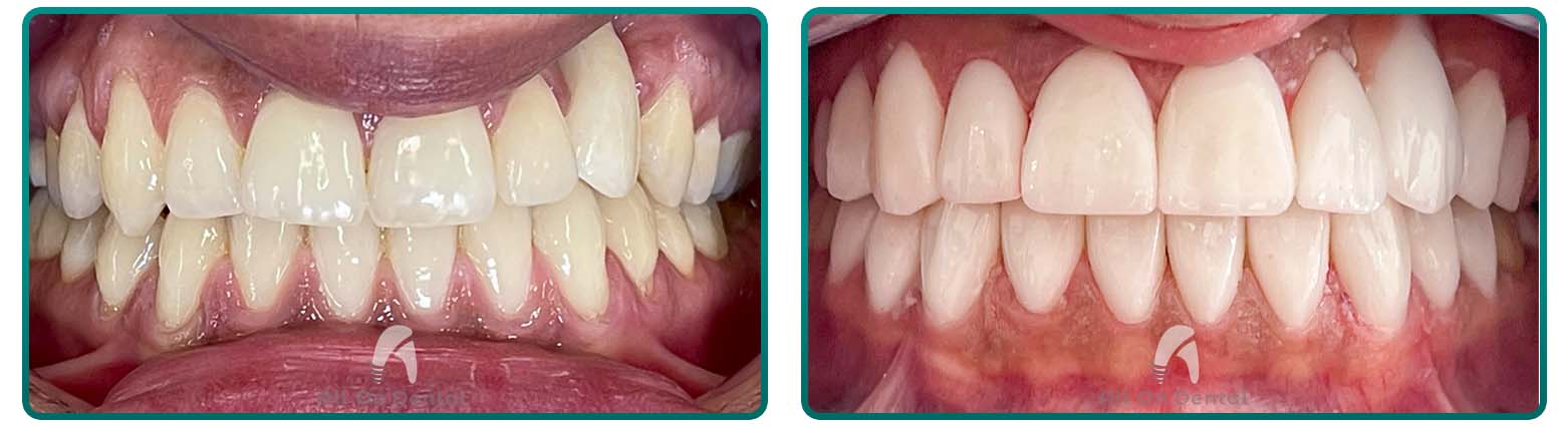 Veneers case 6