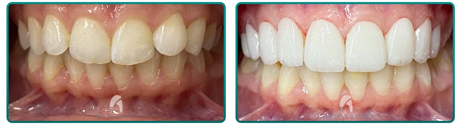 Veneers case 8