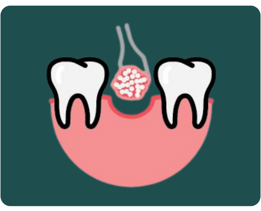 Bone Graft - allondental.com