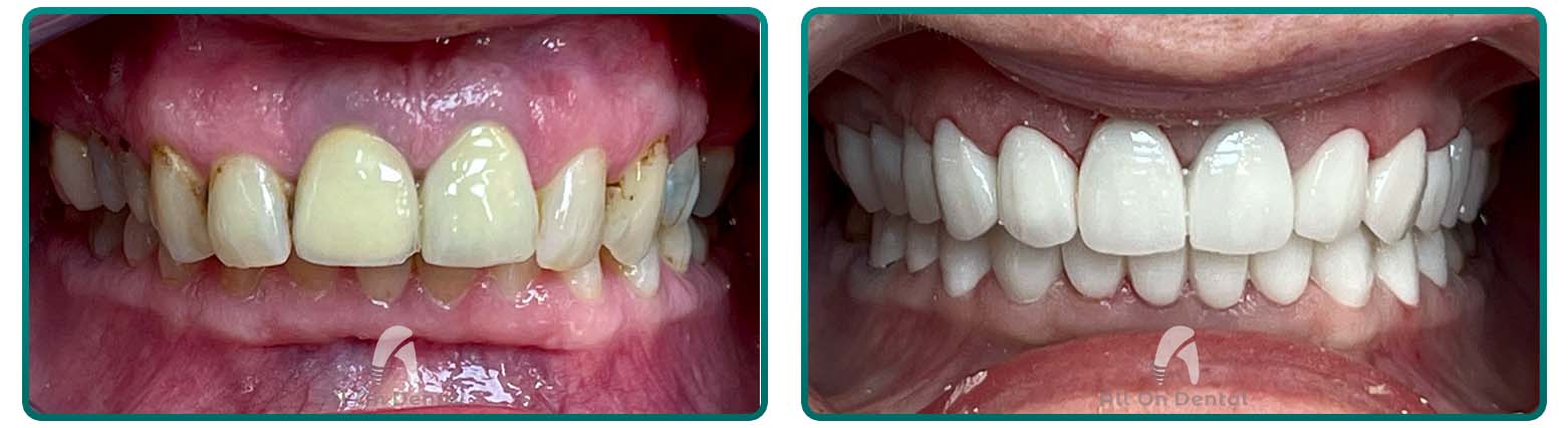 Crowns case 7