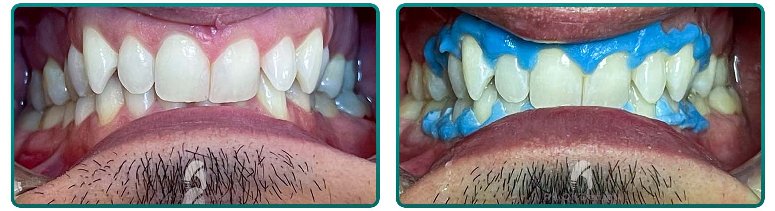 Whitening case 1