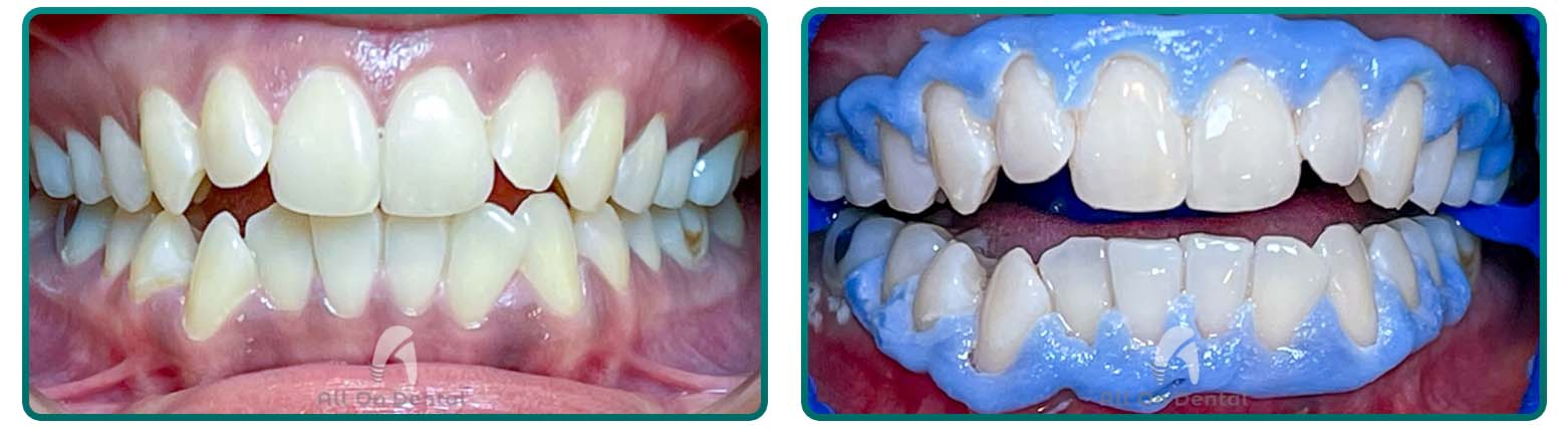 Whitening case 2