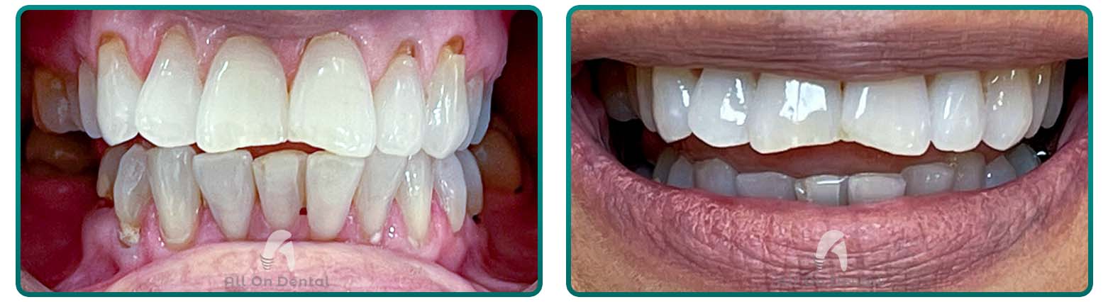 Whitening case 4