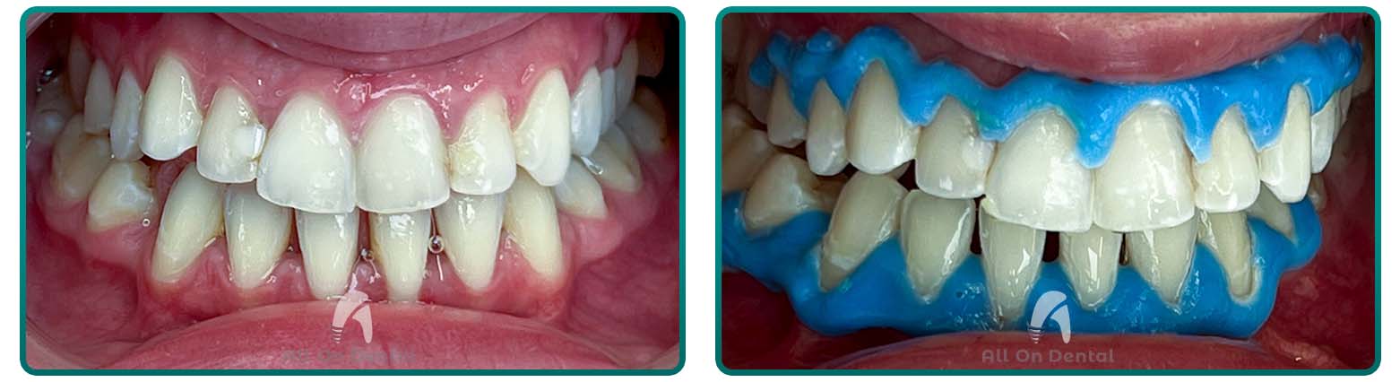 Whitening case 6